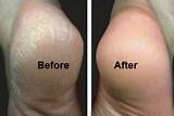 Best Treatment For Corns And Calluses Pictures