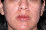 How Much Is Laser Skin Treatment For Acne Scars Pictures