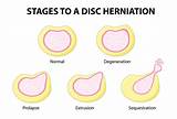 Paracentral Disc Protrusion Treatment Options Images
