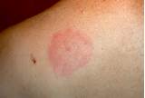 Pictures of Does Heat Kill Scabies
