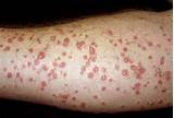 Silver Plaque Psoriasis Images