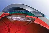 Recovery Time For Cataract Surgery Iol Implant Pictures