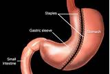 Gas After Gastric Sleeve