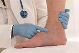 Blood Clot In Foot Treatment At Home Images