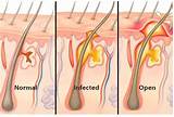 Can You Drain A Pilonidal Cyst At Home Images