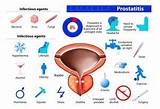 Prostatectomy Recovery Tips Photos