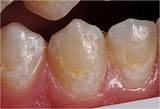 White Spot Removal Teeth