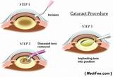 Cataract Surgery Recovery Driving Images
