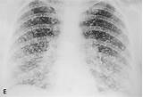Calcium In Lungs Treatment Images