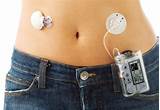 Pictures of What Is An Insulin Pump