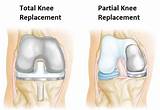 Partial Knee Surgery Recovery Images
