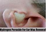 Images of Remove Ear Wax Hydrogen Peroxide