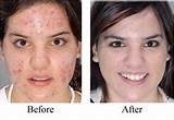 Images of How To Get Rid Of Freckles Laser Treatment