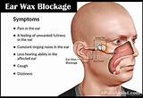 Wax Impaction Home Remedies Pictures