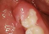 Gum Inflammation Medication Pictures