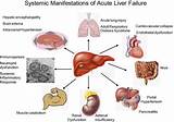Pictures of Symptoms Of Liver Damage From Medication