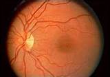 Images of Can Diabetic Retinopathy Be Cured