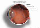 Photos of Retinal Detachment Surgery Gas Bubble