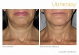 How Much Does Ultherapy Treatment Cost Images