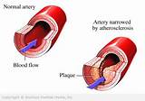 Heart Blockage Symptoms Mayo Clinic Photos