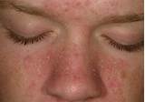 Seborrheic Dermatitis Eyelids Treatment Photos