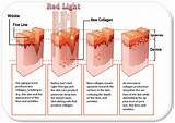 Pictures of Red Light Therapy For Eczema