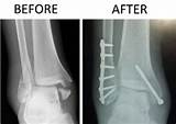 Images of Distal Fibula Fracture Recovery Time