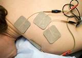 Images of Electric Stimulation Therapy Side Effects