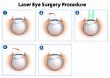 Pictures of Side Effects Of Lasik Eye Surgery India