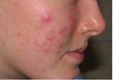 Photos of Home Remedies To Take Redness Out Of Pimples