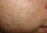 Pimple Spot Removal Pictures