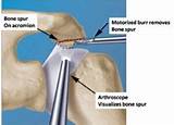 Pictures of Physical Therapy For Rotator Cuff Surgery Recovery