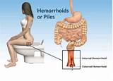 Images of Hemorrhoid Laser Surgery Recovery Time