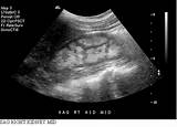 Medical Renal Disease Ultrasound Pictures