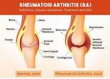 Pictures of Home Treatment For Rheumatoid Arthritis