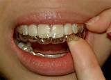 Images of How To Clean Orthodontic Retainers