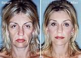 Pictures of Post Facelift Recovery
