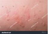 Photos of Severe Allergic Skin Reaction Treatment