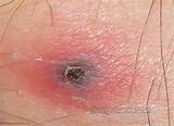 Pictures of Spot On Tick Removal