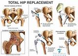 Images of Hip Bone Surgery Recovery Time