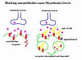 Myasthenia Gravis Holistic Treatment Photos