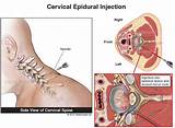 Cervical Spine Disc Bulge Treatment Images