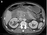 Images of Management Of Pancreatic Rest