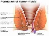 Hemorrhoids And Gas Photos
