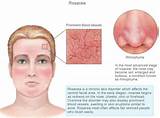 Rosacea Treatment Topical Medications Images