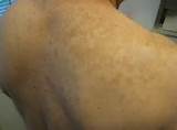 Doctor For Skin Rash Pictures
