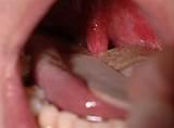 Photos of Allergic Reaction Swollen Tongue Treatment