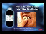 Photos of Oralmax Gum Disease Treatment