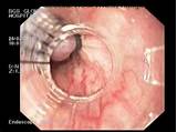 Pictures of Esophageal Varices Banding Recovery