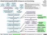 Management Of Dilated Cardiomyopathy